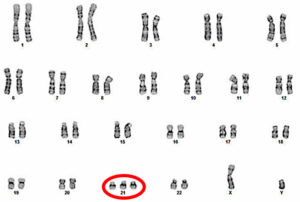 down syndrome chromosomes affected